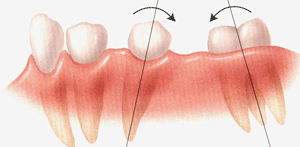 Последствия утраты зуба