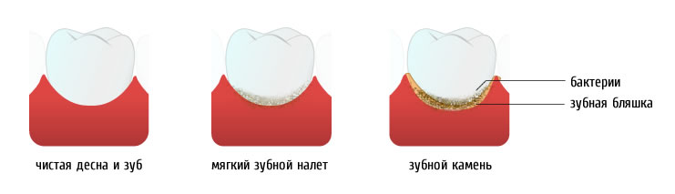 Зубной налет