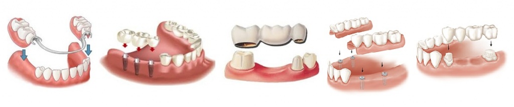 протезирование зубов до и после