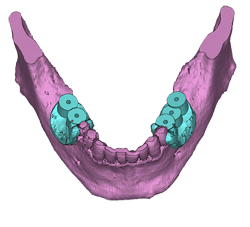 Трехмерная модель челюсти с шаблонами