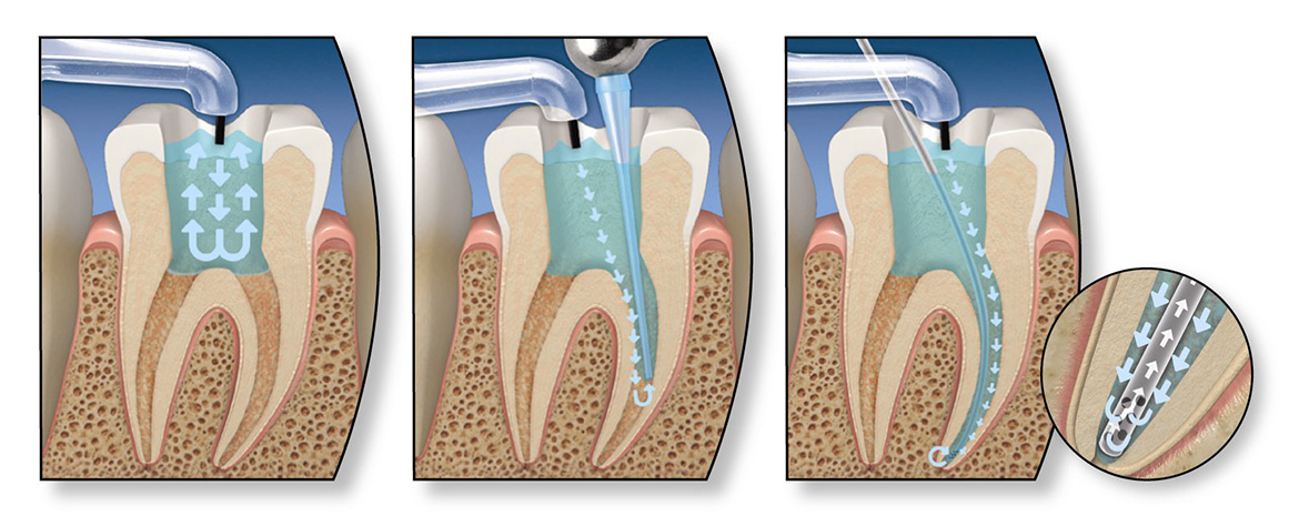 Периодонтит зуба: методы лечения, симптомы и цены