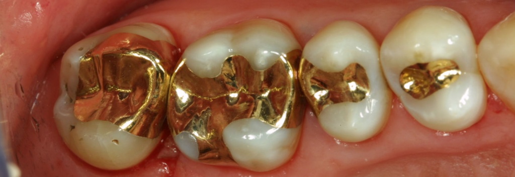 Стоматологические вкладки из золота