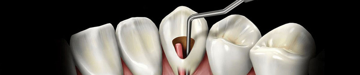 ампутация корня зуба в стоматологии