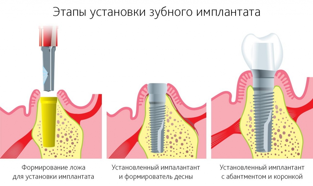Одноэтапная методика имплантации зубов