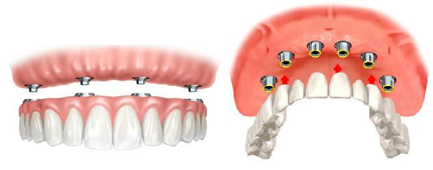 Комбинированные зубные протезы