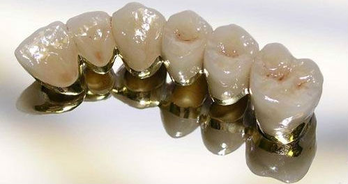 Металлокерамические зубные коронки на каркасе из золота