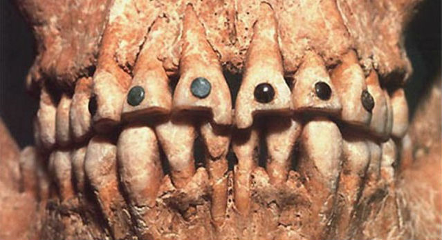 Зубы с камнями
