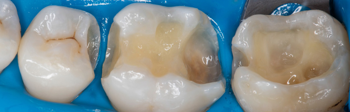 реставрация жевательных зубов
