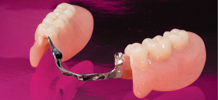Бюгельные зубные протезы