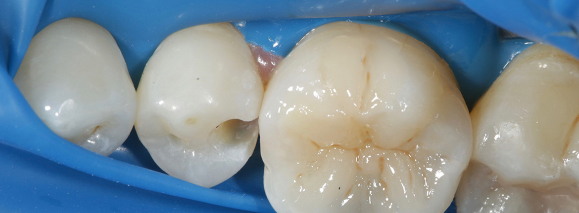 реставрация жевательного зуба композитным материалом