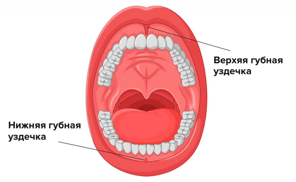 Рассечение уздечки нижней губы