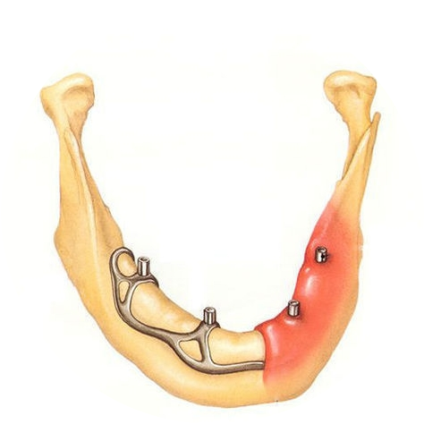 Субпериостальная (поднадкостничная) имплантация зубов