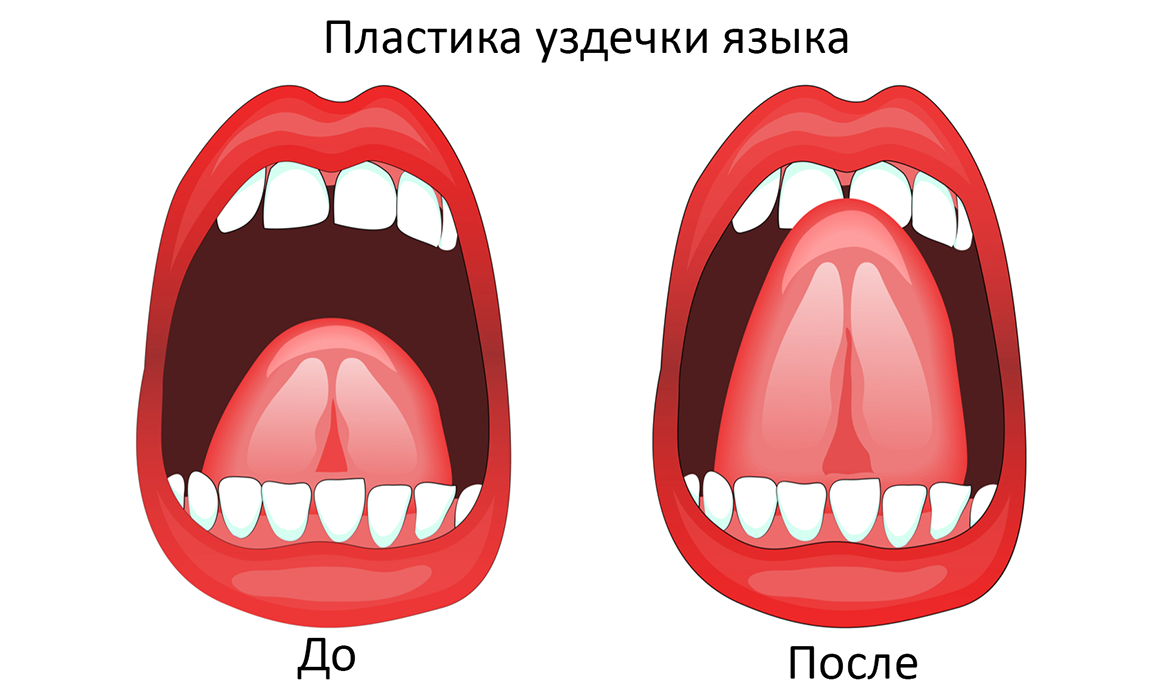 Рассечение уздечки верхней губы