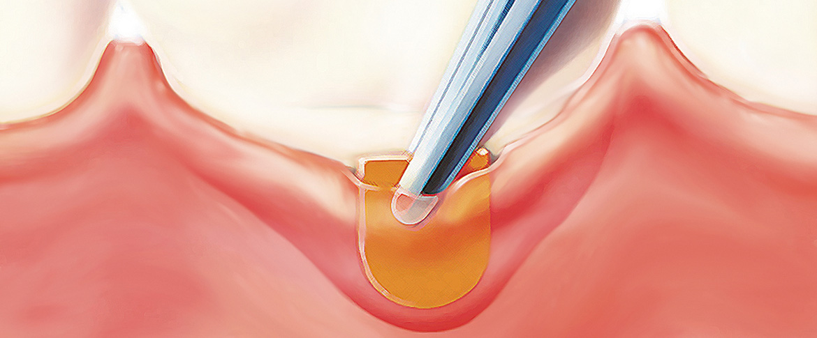 Пародонтальный абсцесс и его лечение - САИДА - клиника стоматологии