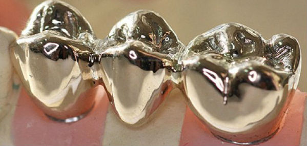 Цельнометаллические зубные коронки