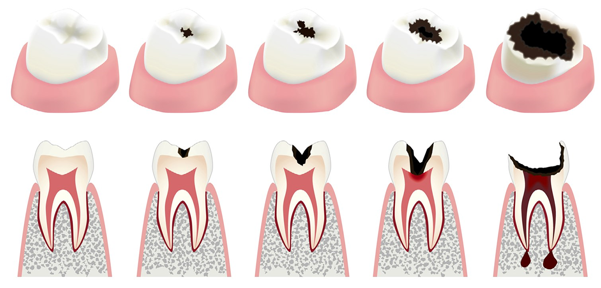 Некариозные поражения зубов. Часть II