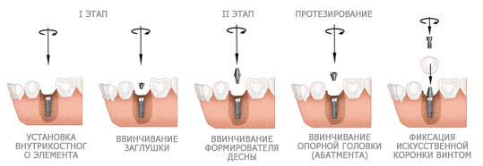 Двухэтапная методика имплантации зубов