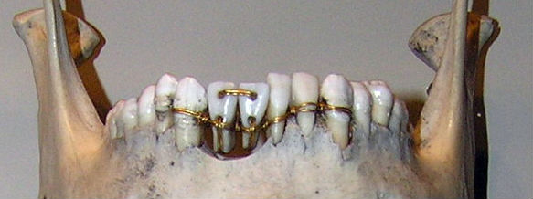 Первые стоматологи сверлили зубы полторы тысячи лет