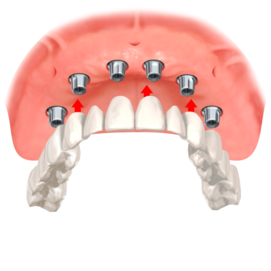 нутрислизистая имплантация зубов